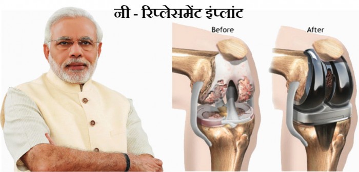 पीएम मोदी का तोहफा नी-रिप्लेसमेंट इंप्लांट की कीमत 65 प्रतिशत तक हुई कम