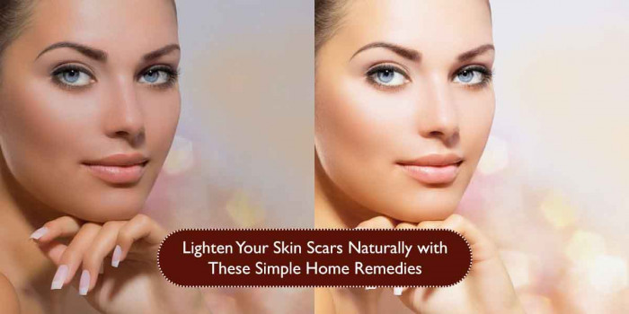 7 Simple Natural Home Remedies to Lighten Your Skin Scars