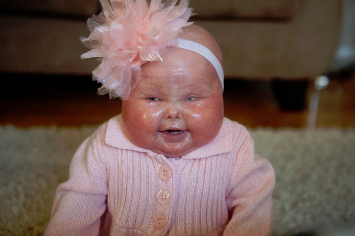 8 Most Notable Cases Of Harlequin Baby That Will Give You Goosebumps