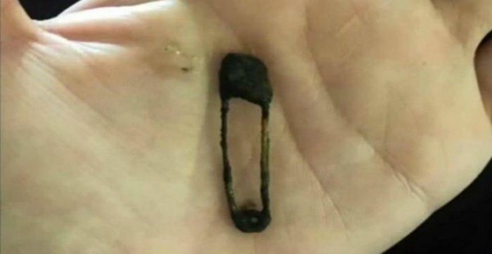 A 5 year Old Girl Stuck A Safety Pin In Her Nose For 6 Months