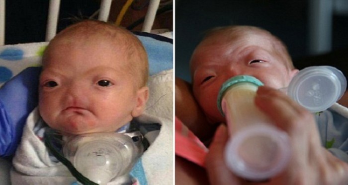 A Truly Inspirational Story of the 2 Kids Born Without Nose