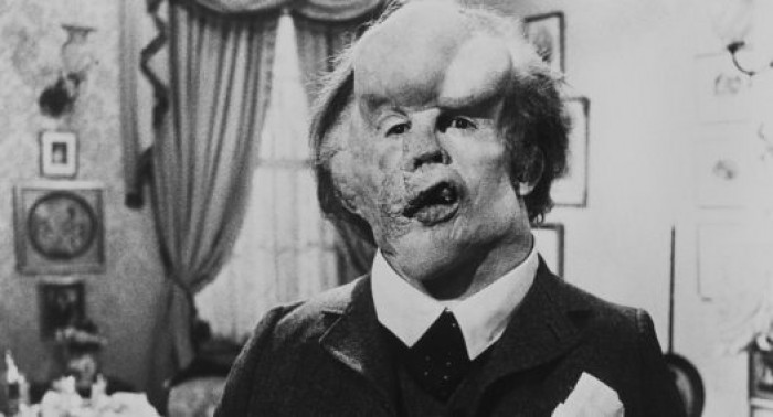 5 Facts About the Elephant Man “Joseph Merrick”