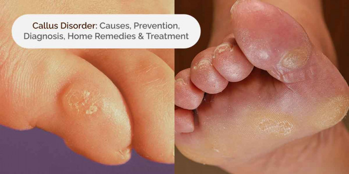 Know the Causes, Symptoms, Prevention & Treatment of Callus Disorder