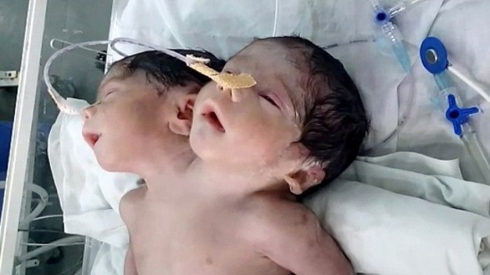 Sadly! Baby Boy Born With 2 Heads Couldn't Survive More Than 32 Hour