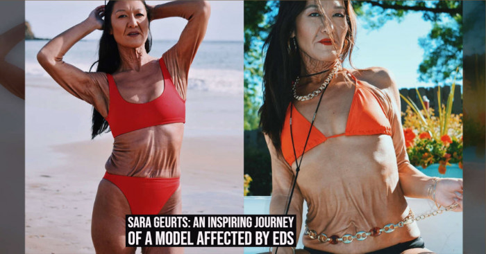 Sara Geurts: A Model Who Inspires Everyone to be Confident in Their Skin