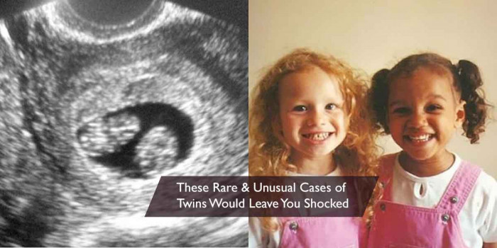 The Extremely Rare and Unusual Cases of Twins Ever Born in the World